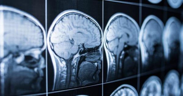 x-ray on brain
